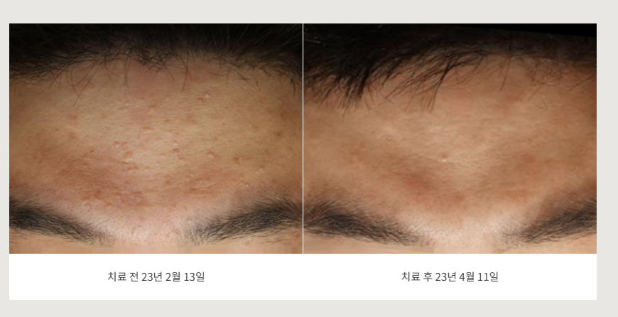 춘천 편평사마귀 이마 치료 전후사진
