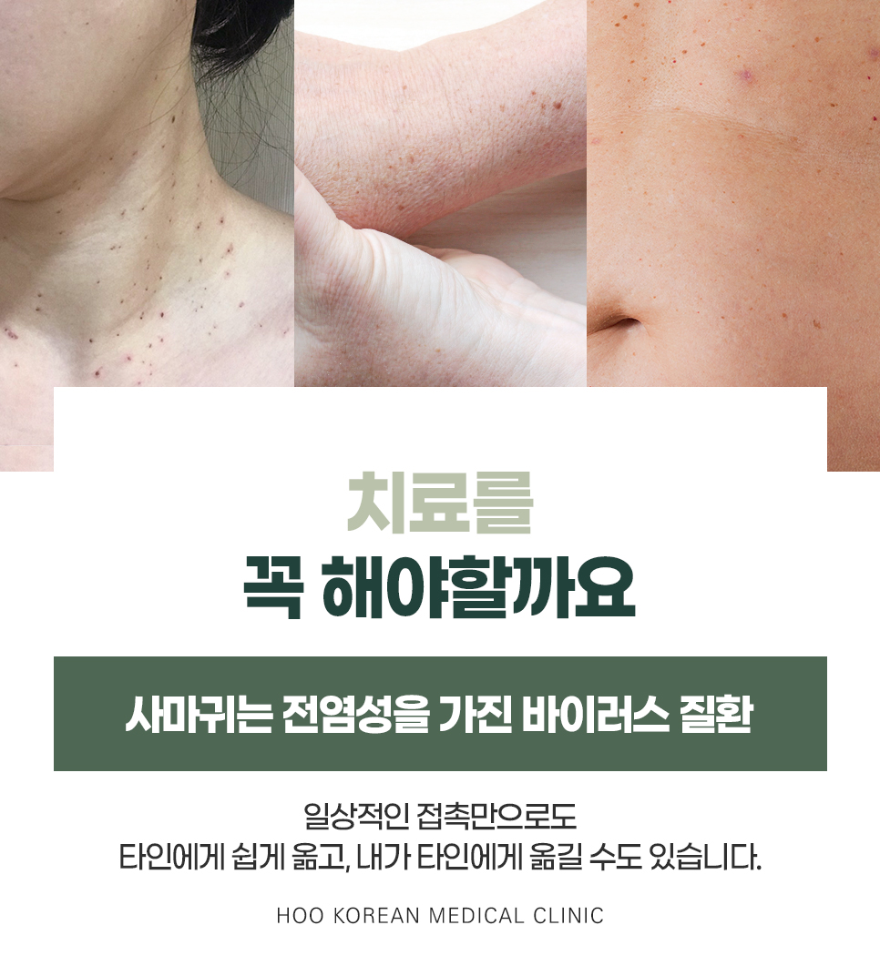 편평사마귀 전염성 신체 부위별 발생 사진