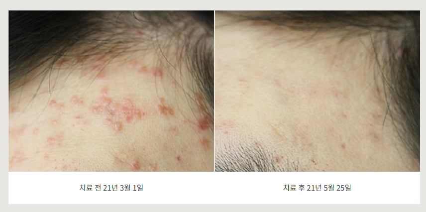 춘천 편평사마귀 헤어라인 치료 전후사진