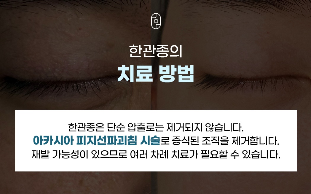 한관종 아카시아 피지선파괴침 치료방법 설명