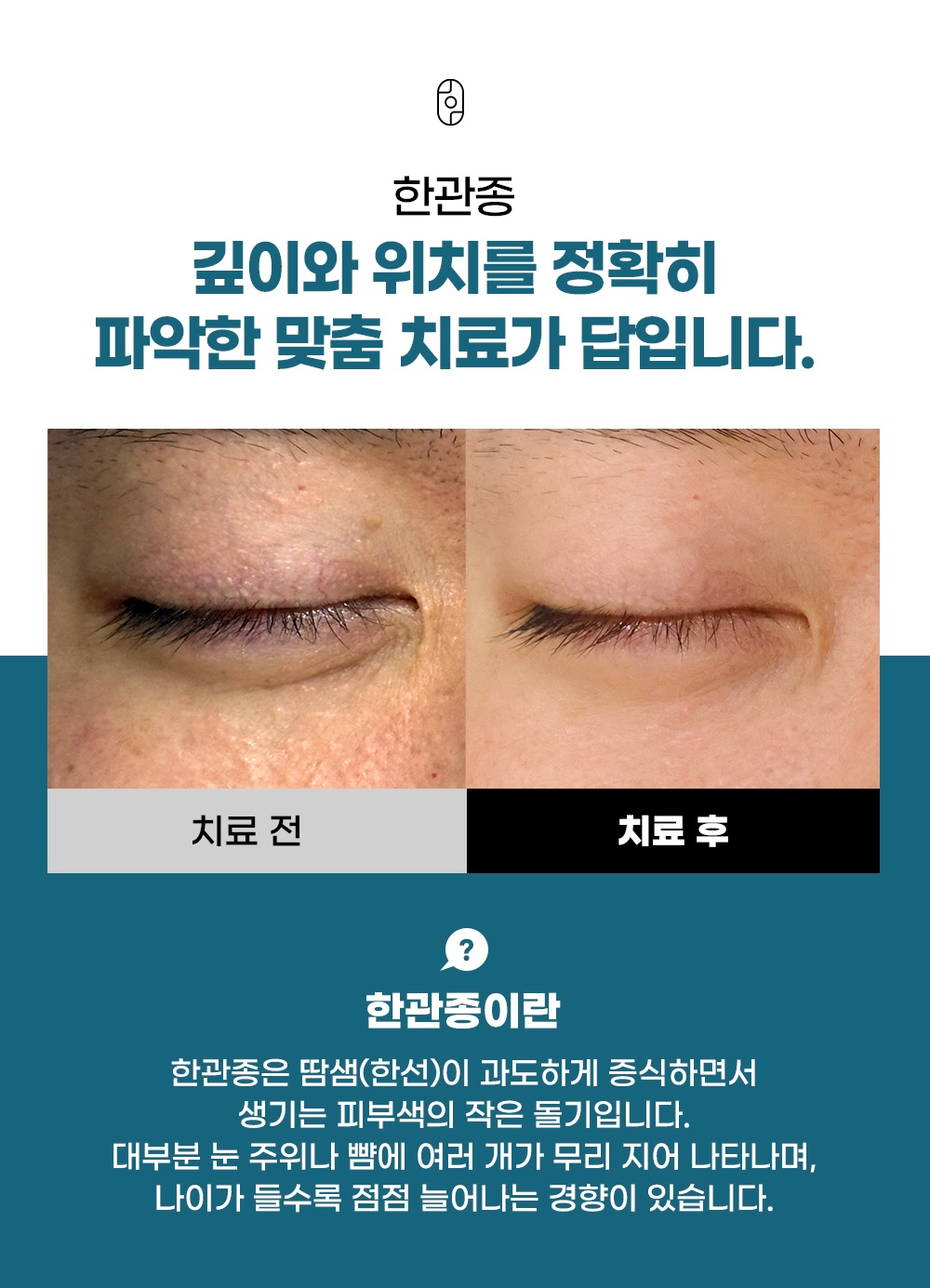 한관종 치료 전후 눈가 비교 사진과 정의 설명
