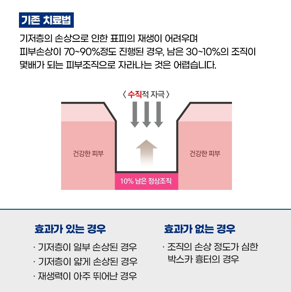 기존 여드름 흉터 치료법의 한계 - 수직 자극 방식과 효과 유무 비교
