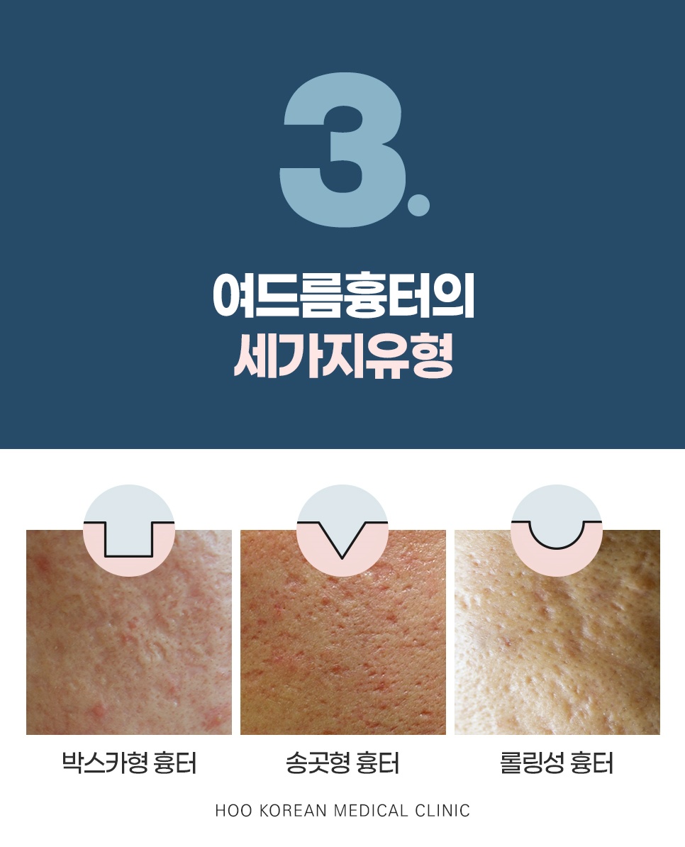여드름 흉터 세 가지 유형 - 박스카형, 송곳형, 롤링성 흉터 비교 사진