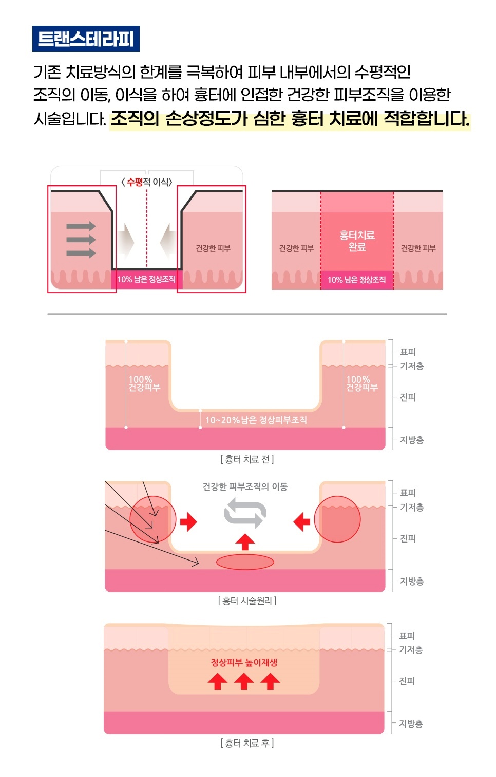 트랜스테라피 시술 원리 - 건강한 피부조직 수평 이식을 통한 흉터 치료 과정