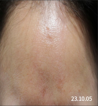 여드름 흉터 치료 후 개선된 이마 피부, 2023년 10월 촬영