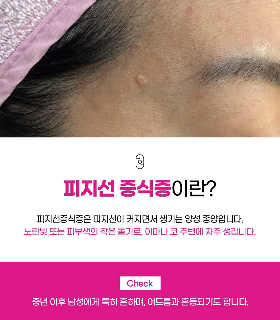 이마에 생긴 피지선 증식증, 노란빛 작은 돌기 모습과 정의 설명