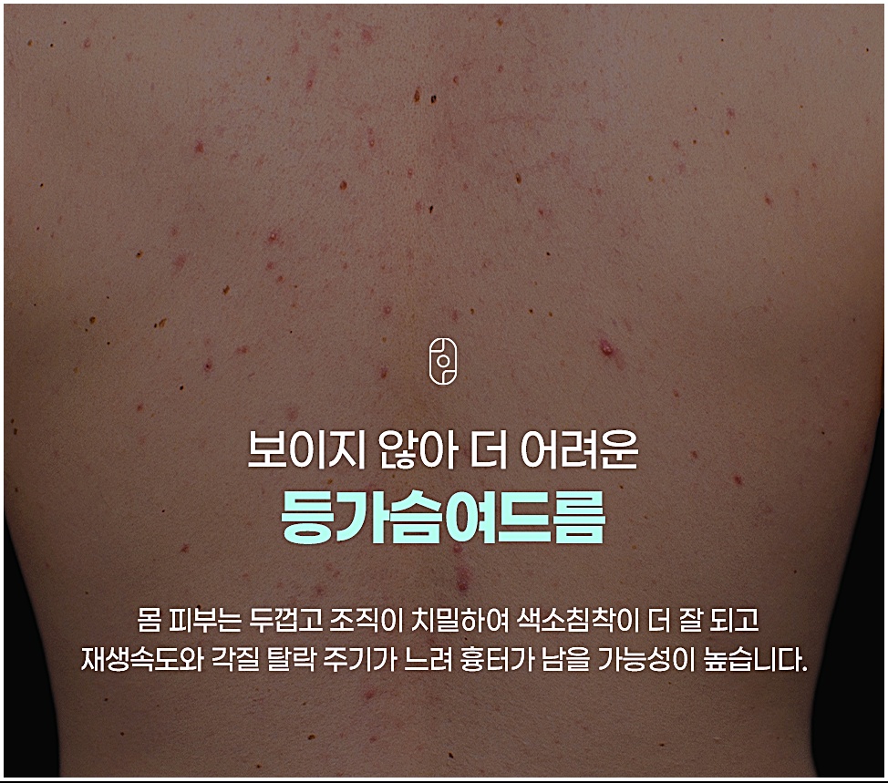 춘천등여드름, 등 전체에 붉은 병변과 색소침착이 나타난 등가슴여드름 피부
