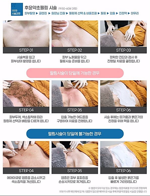후한의원 춘천점 후윤약초필링 시술 과정, 촬영부터 압출·진정까지 단계별 안내