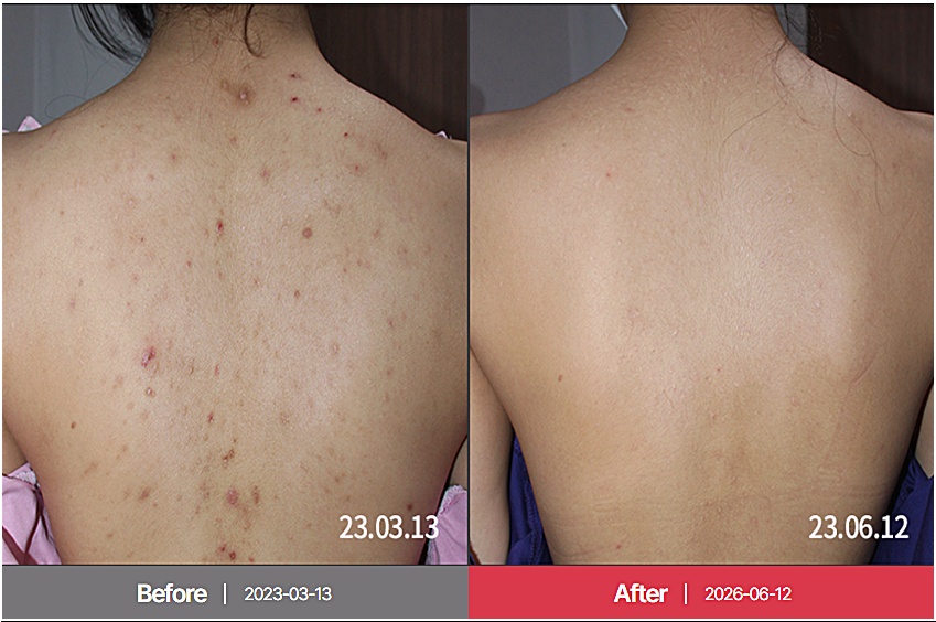 춘천등여드름 후윤약초필링 치료 전후 비교, 등 부위 병변 개선 사진