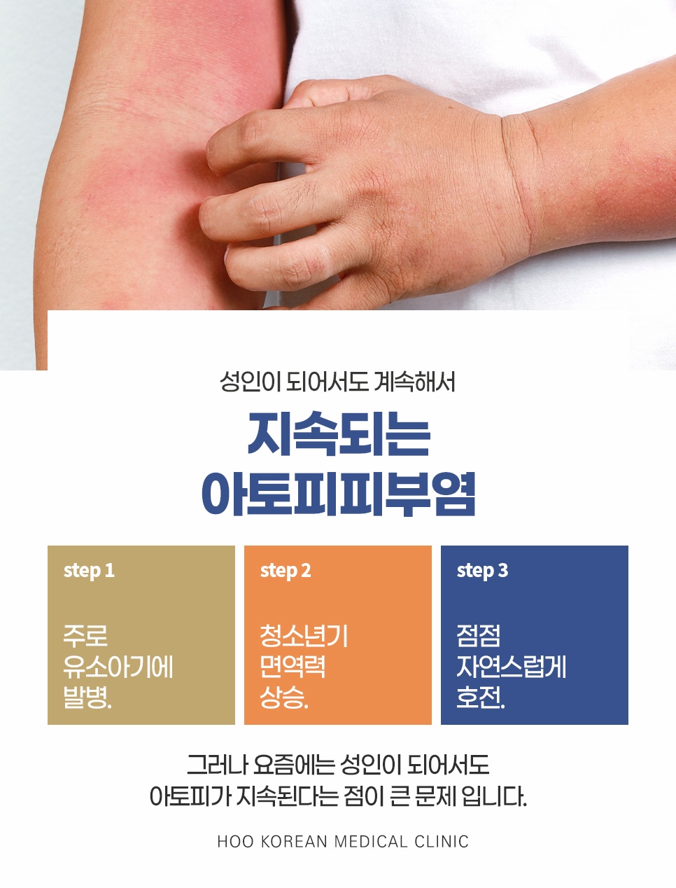 성인까지 지속되는 춘천아토피피부염 연령별 발병 및 진행 과정