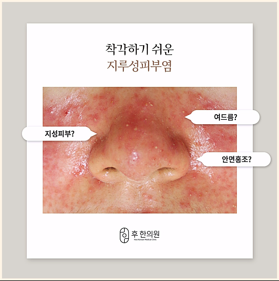 여드름, 지성피부, 안면홍조로 착각하기 쉬운 지루성피부염 코 주변 증상