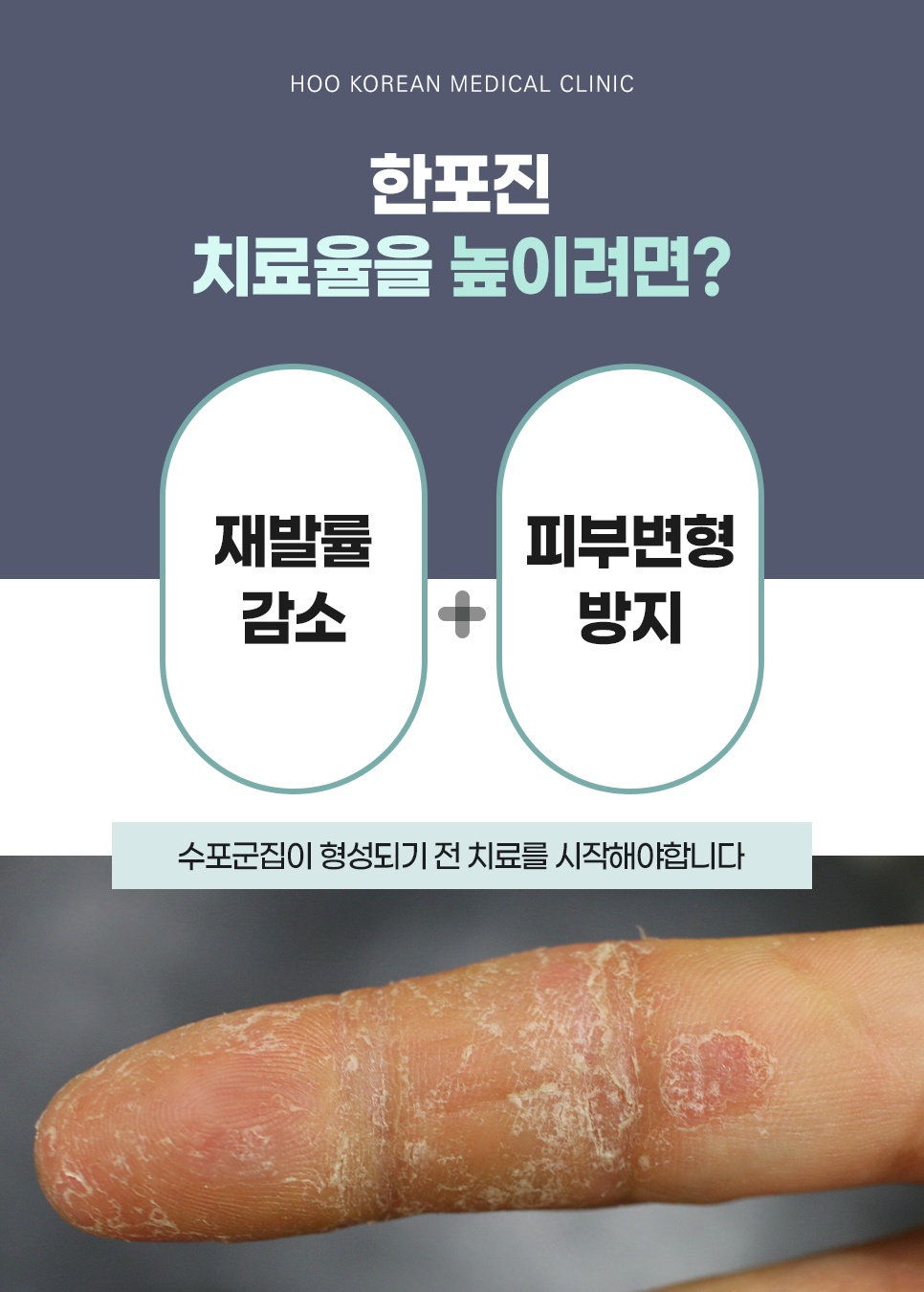 한포진 치료율을 높이기 위한 핵심 키워드