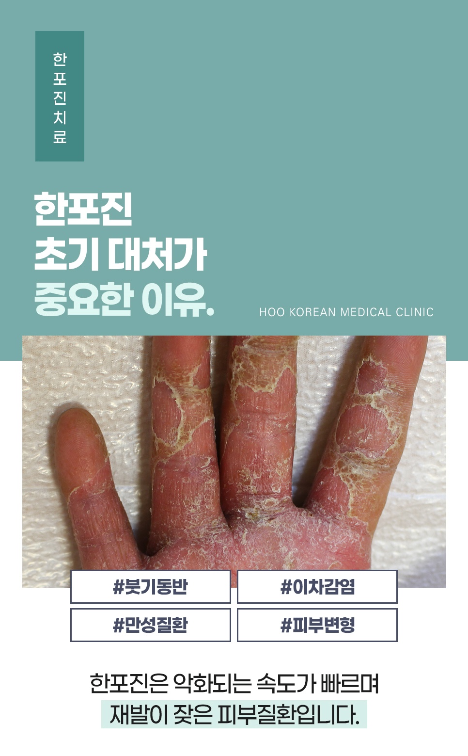 한포진 초기 대처의 중요성