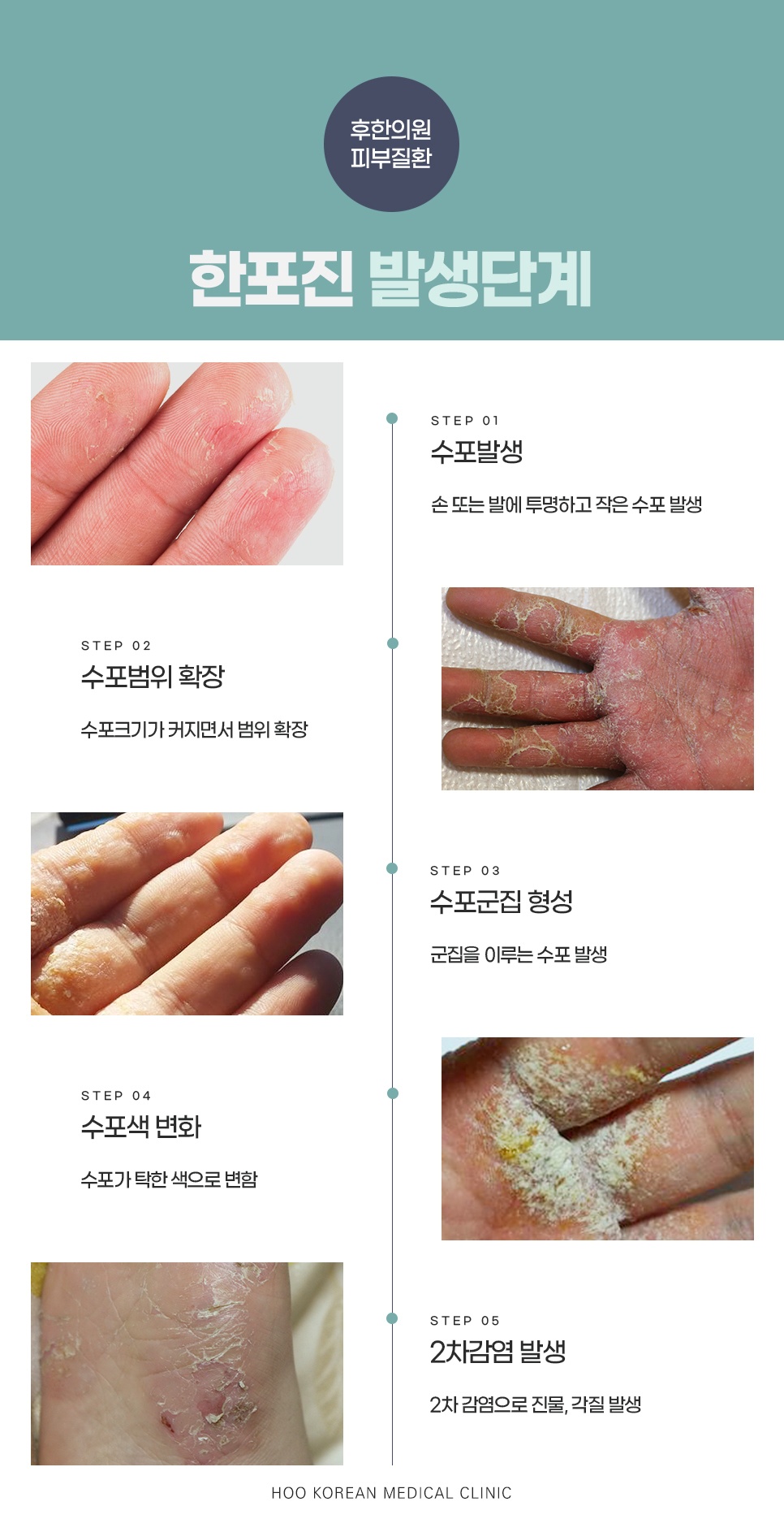 한포진 발생 5단계