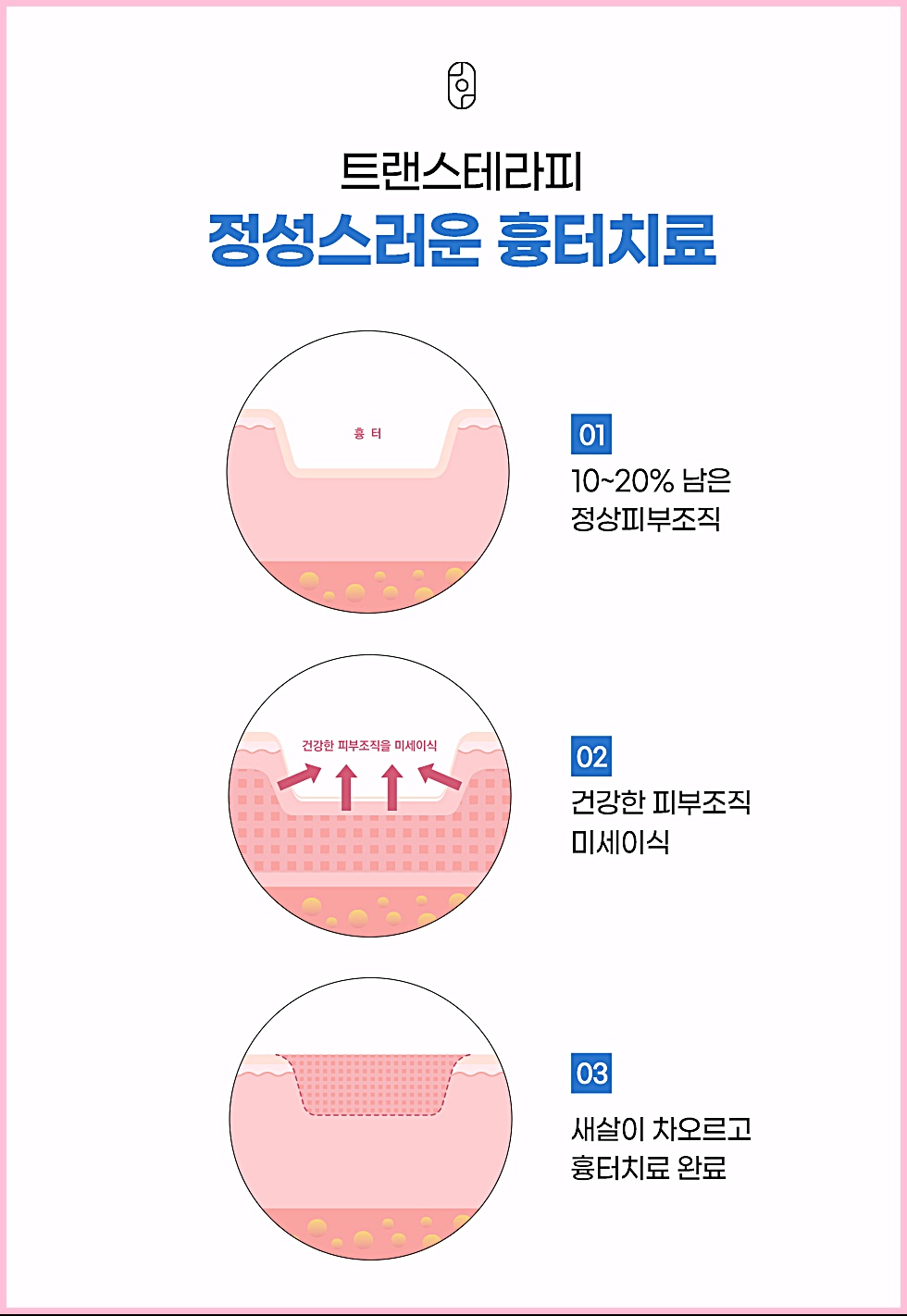 트랜스테라피 정성스러운 흉터치료 원리를 보여주는 3단계 설명