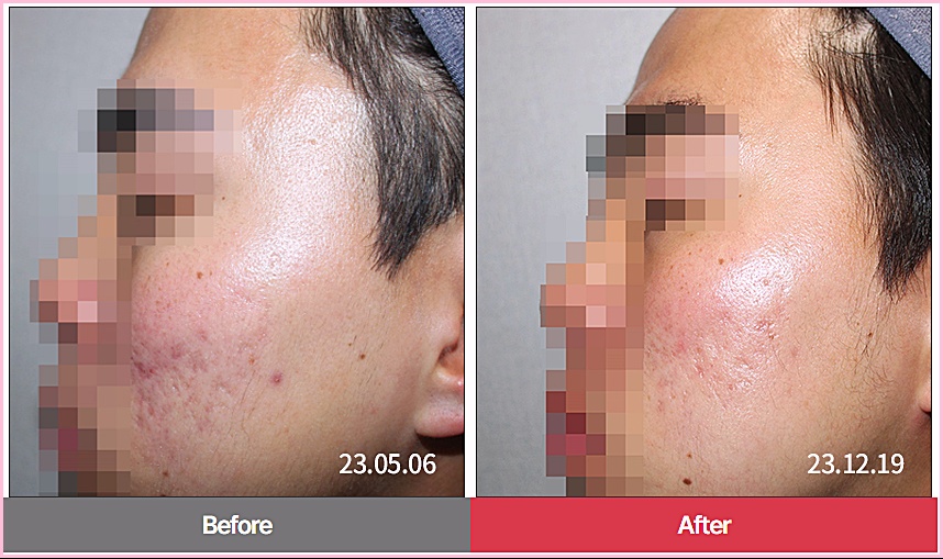 춘천새살침 여드름 흉터 듀얼테라피 치료 전후 비교