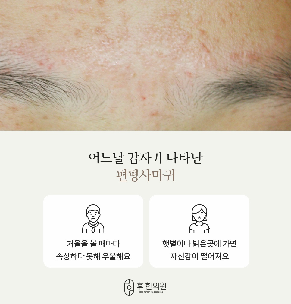 얼굴 및 이마 부위 편평사마귀 증상과 외모 고민 안내