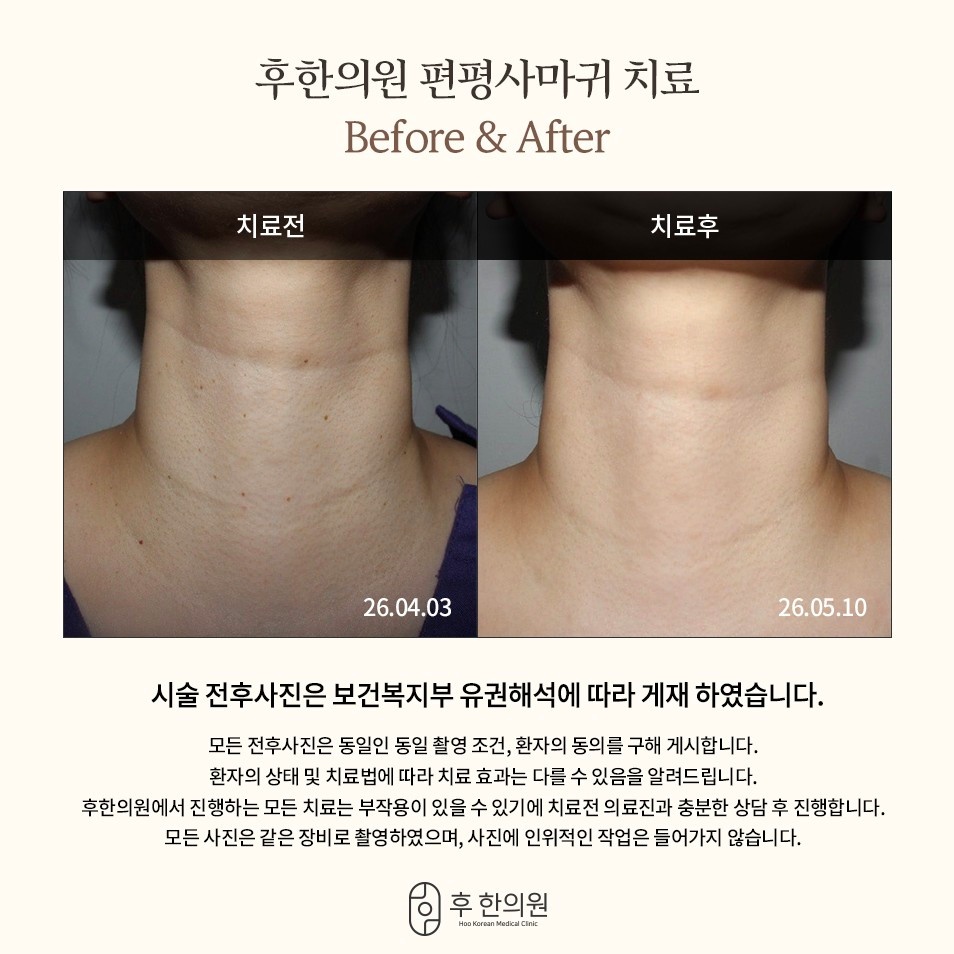 후한의원 춘천점의 목 부위 편평사마귀 침치료 임상 전후 비교 사진