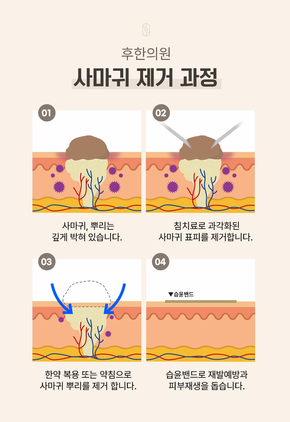 침치료와 한약, 약침을 활용한 후한의원 편평사마귀 제거 4단계 과정