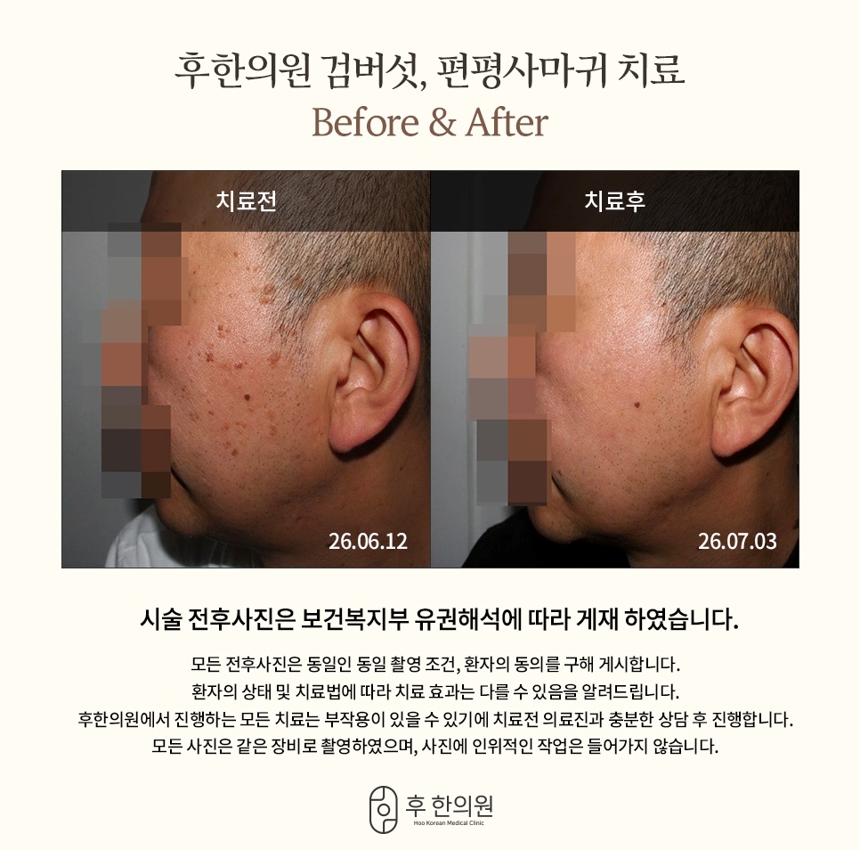 춘천 후한의원 얼굴 검버섯 및 편평사마귀 케어 치료 전후 비교
