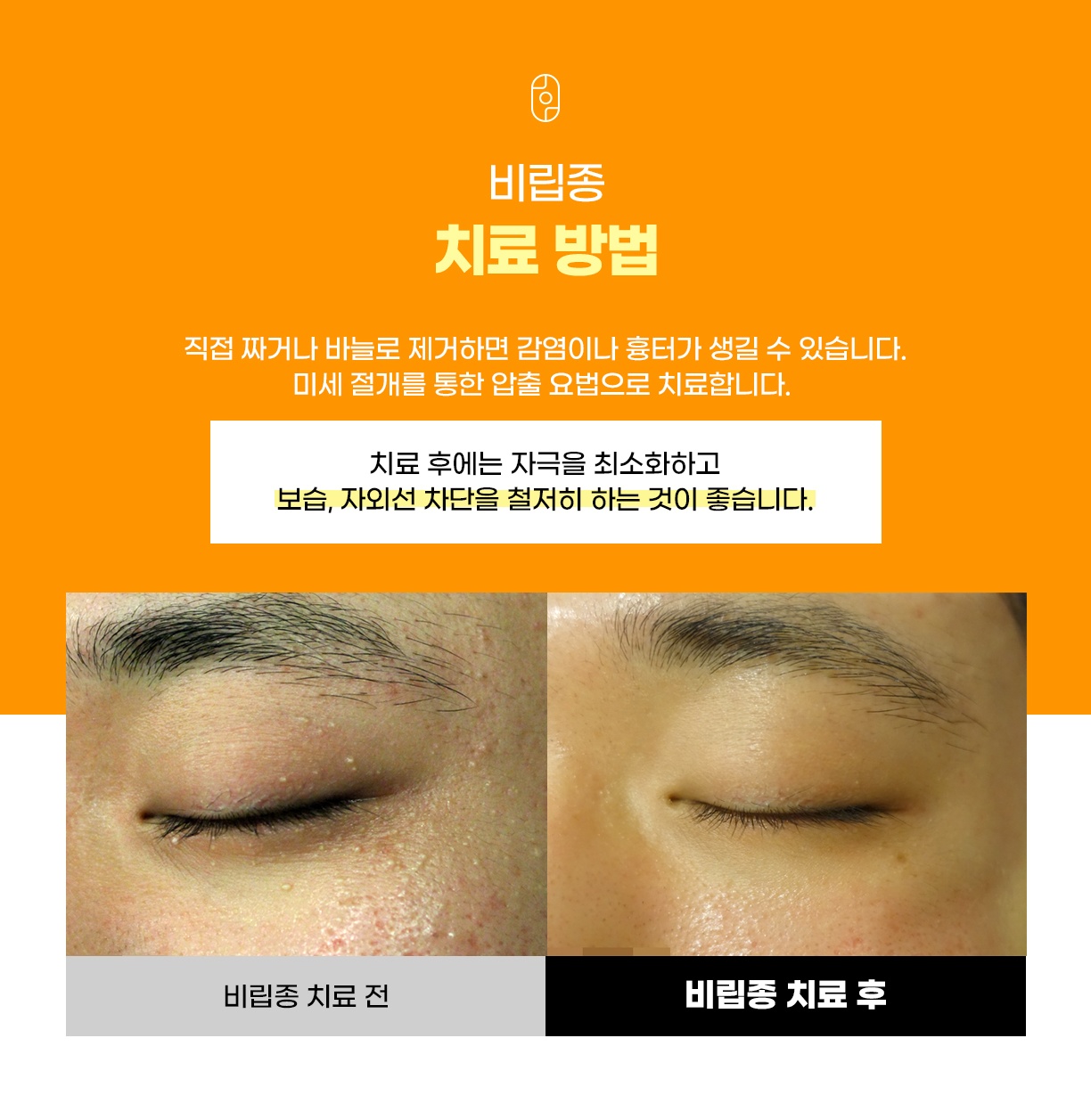 비립종 미세절개 및 압출 치료 방법과 시술 전후 비교