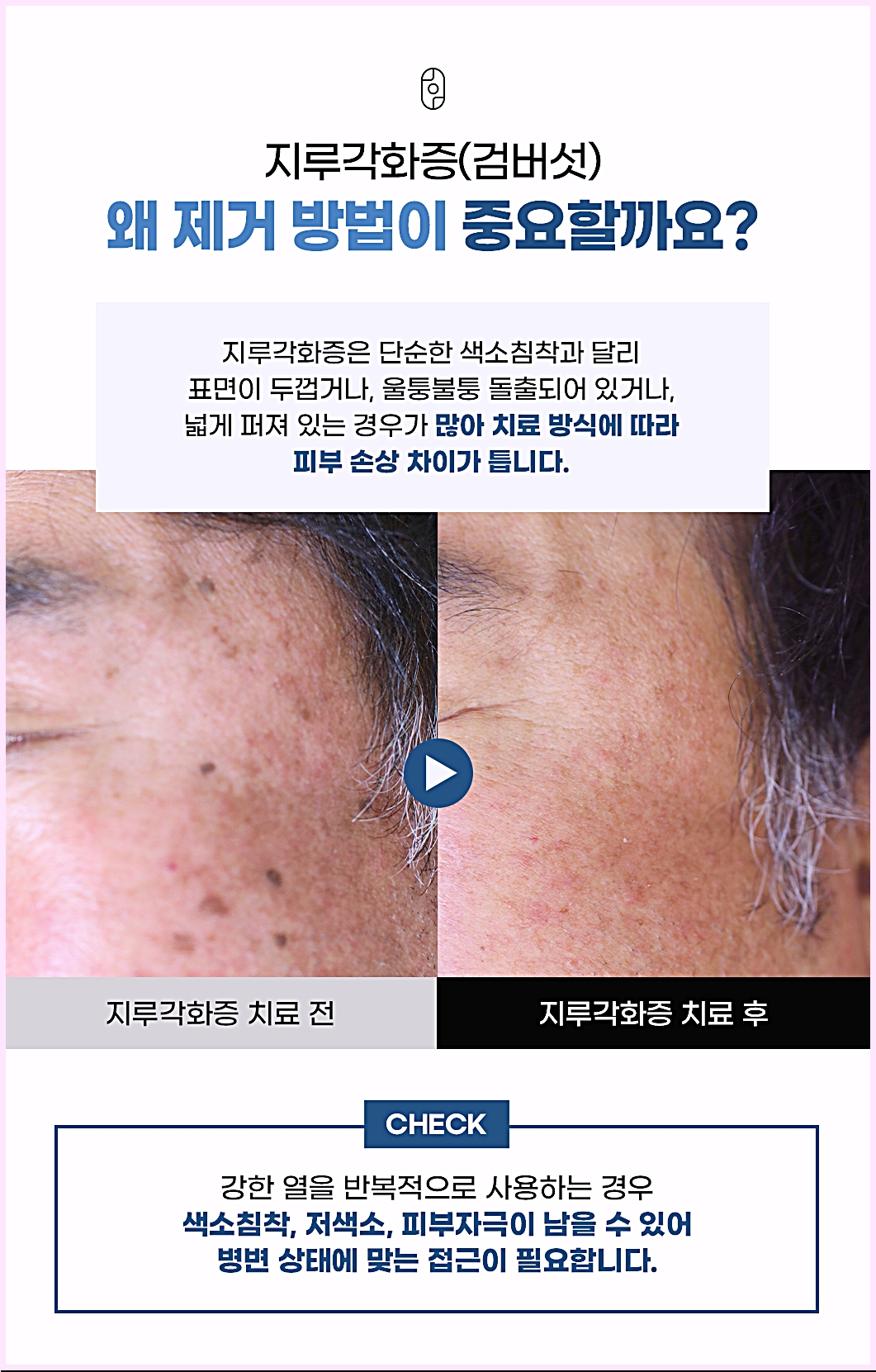 춘천검버섯제거 표면이 두껍거나 돌출된 지루각화증이 치료 방식에 따라 피부 손상 차이가 달라질 수 있음