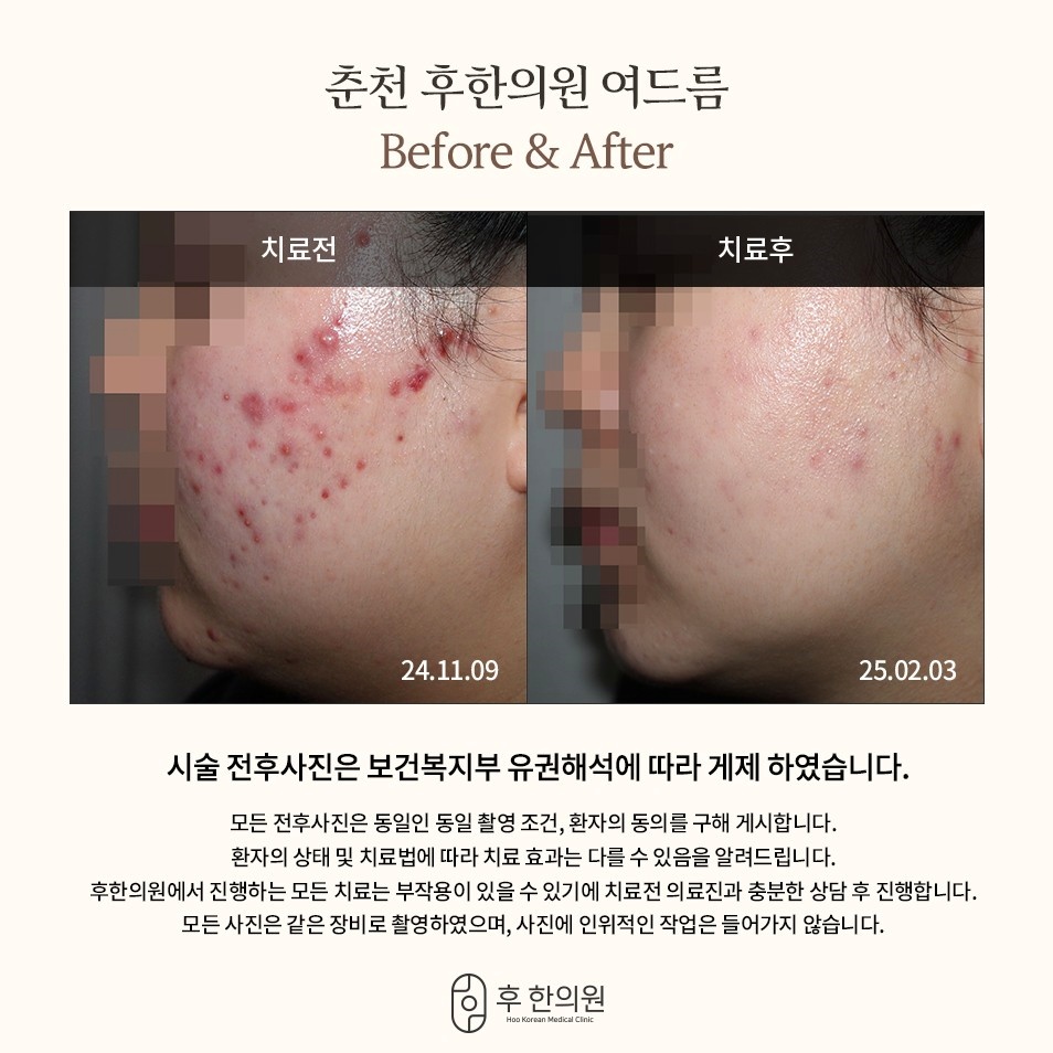 춘천점 24년 11월부터 25년 2월까지 붉은 볼 여드름 변화를 비교한 전후 사진