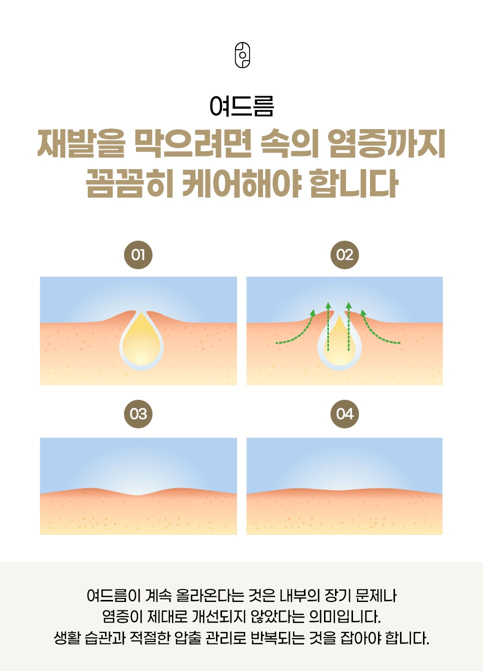 모공 속 염증이 빠져나가 피부가 평평해지는 4단계로 보는 여드름 재발 관리 도해