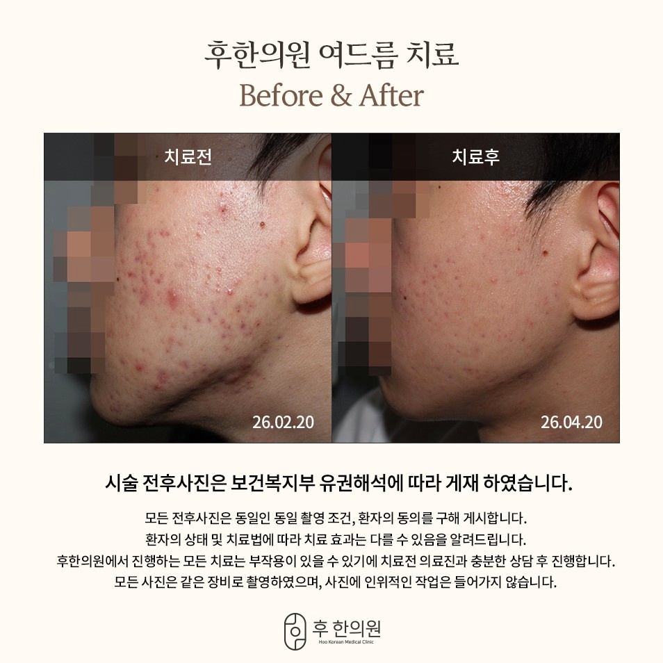 26년 2월과 4월, 턱선을 따라 퍼진 붉은 여드름의 두 달 변화 전후 사진