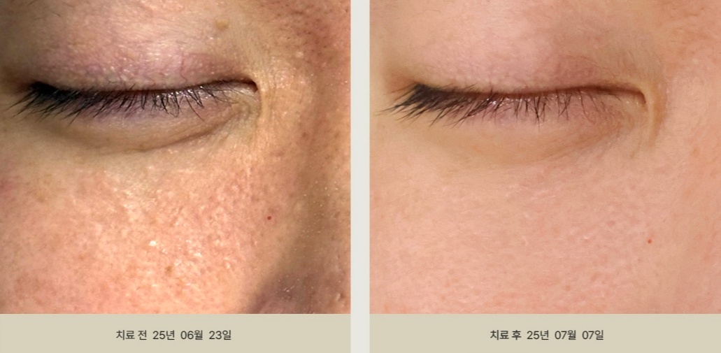 25년 6월 23일 치료 전과 2주 뒤인 7월 7일 치료 후를 비교한 눈 밑 한관종 사진