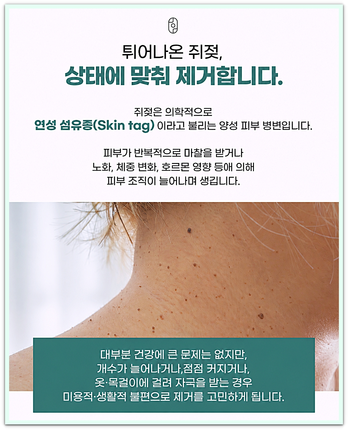 목과 어깨 피부에 작은 쥐젖이 여러 개 보이는 모습과 쥐젖(연성 섬유종)을 설명