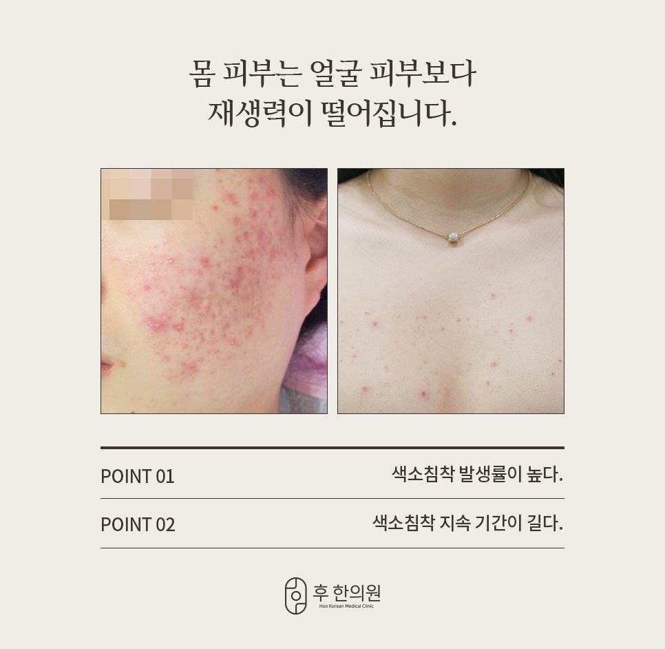 얼굴 볼 여드름과 가슴 여드름 사진으로 보는 몸 피부 색소침착 발생률·지속 기간 안내