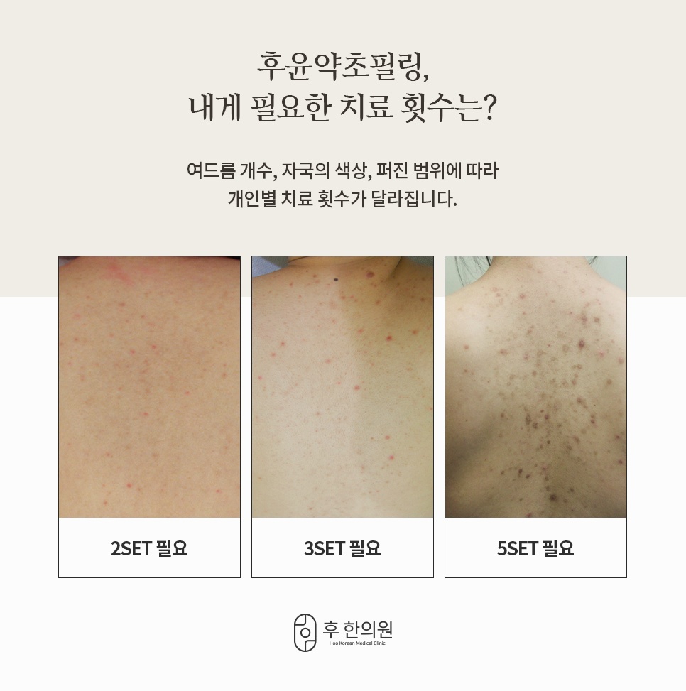 등 여드름 개수와 자국 색상에 따라 2세트·3세트·5세트로 나눈 필링 치료 횟수 안내