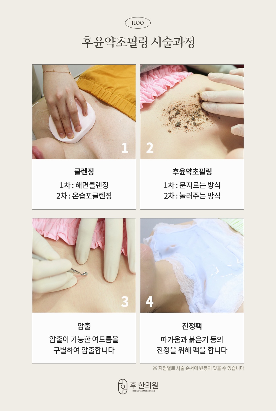 해면·온습포 클렌징, 필링, 압출, 진정팩으로 이어지는 후윤약초필링 시술과정 4단계
