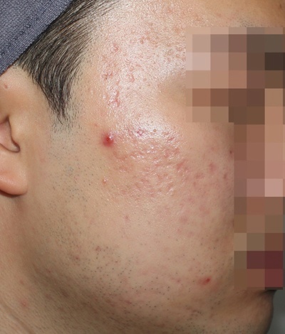 춘천 여드름흉터 치료 전