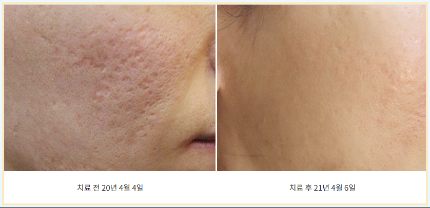 춘천여드름흉터치료 트랜스테라피 볼 패임 치료 전후