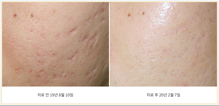 춘천 여드름흉터 패임 치료 전후 비교
