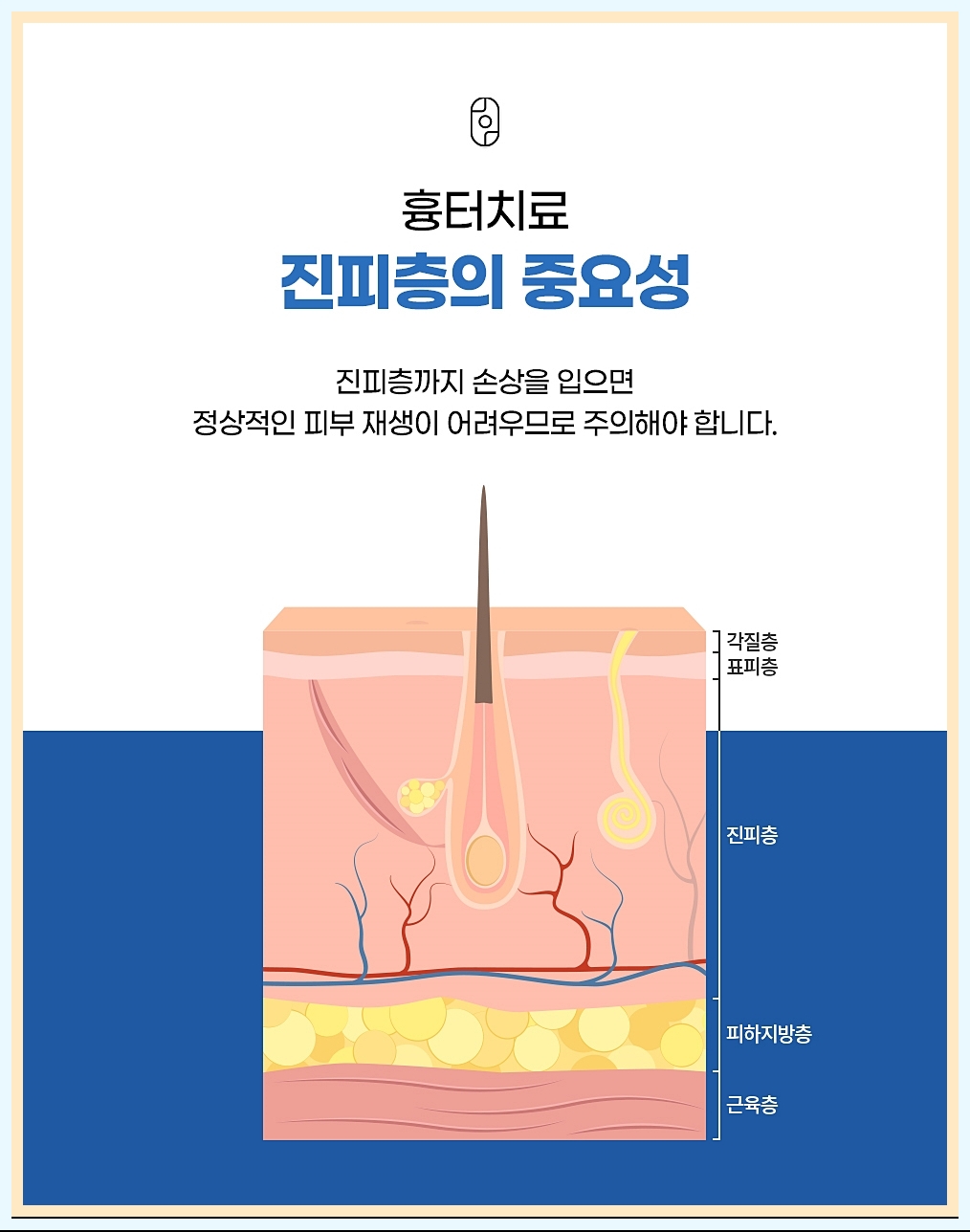 흉터 치료 시 진피층의 중요성 강조 이미지