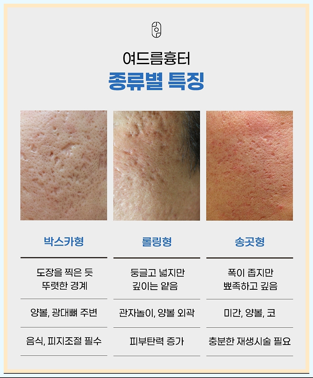 춘천여드름흉터치료 종류별 흉터의 특징 정리 이미지