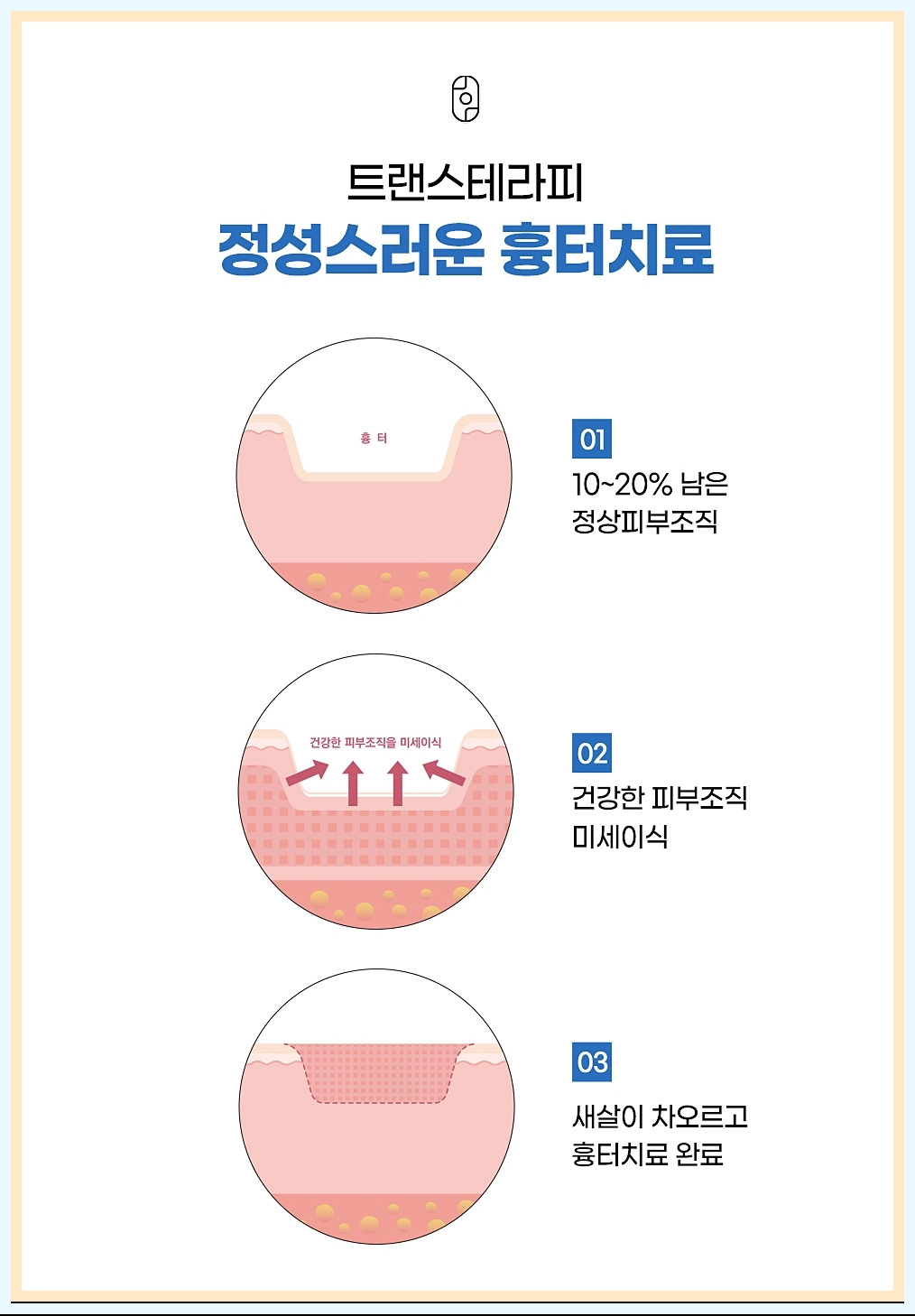 트랜스테라피의 흉터 치료 과정