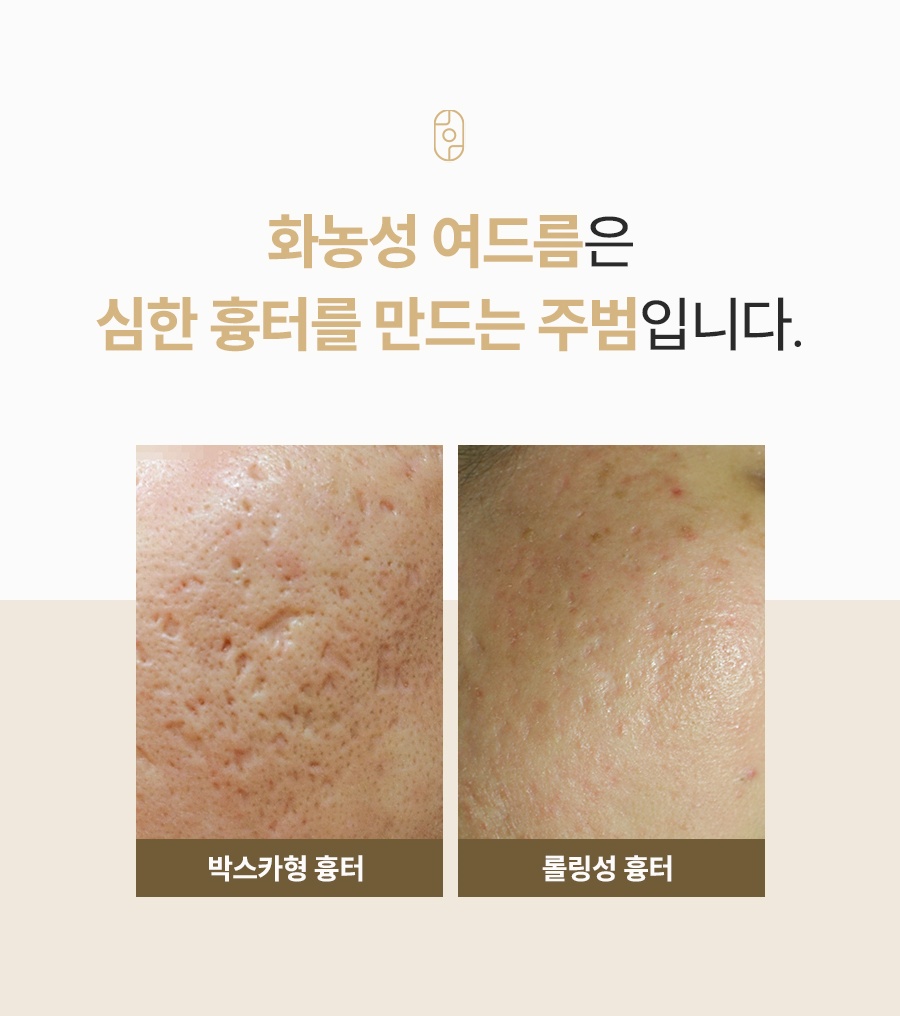 조기 치료가 중요한 화농성 여드름 주의 안내