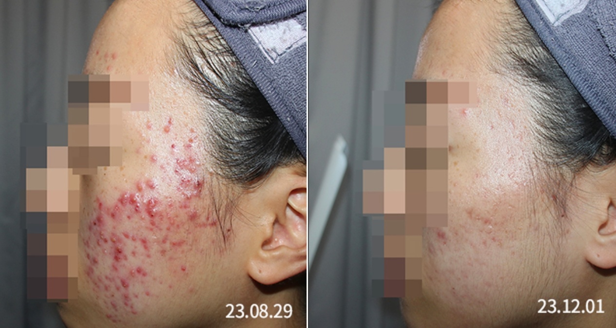 화농성여드름 3개월 치료 전후 경과