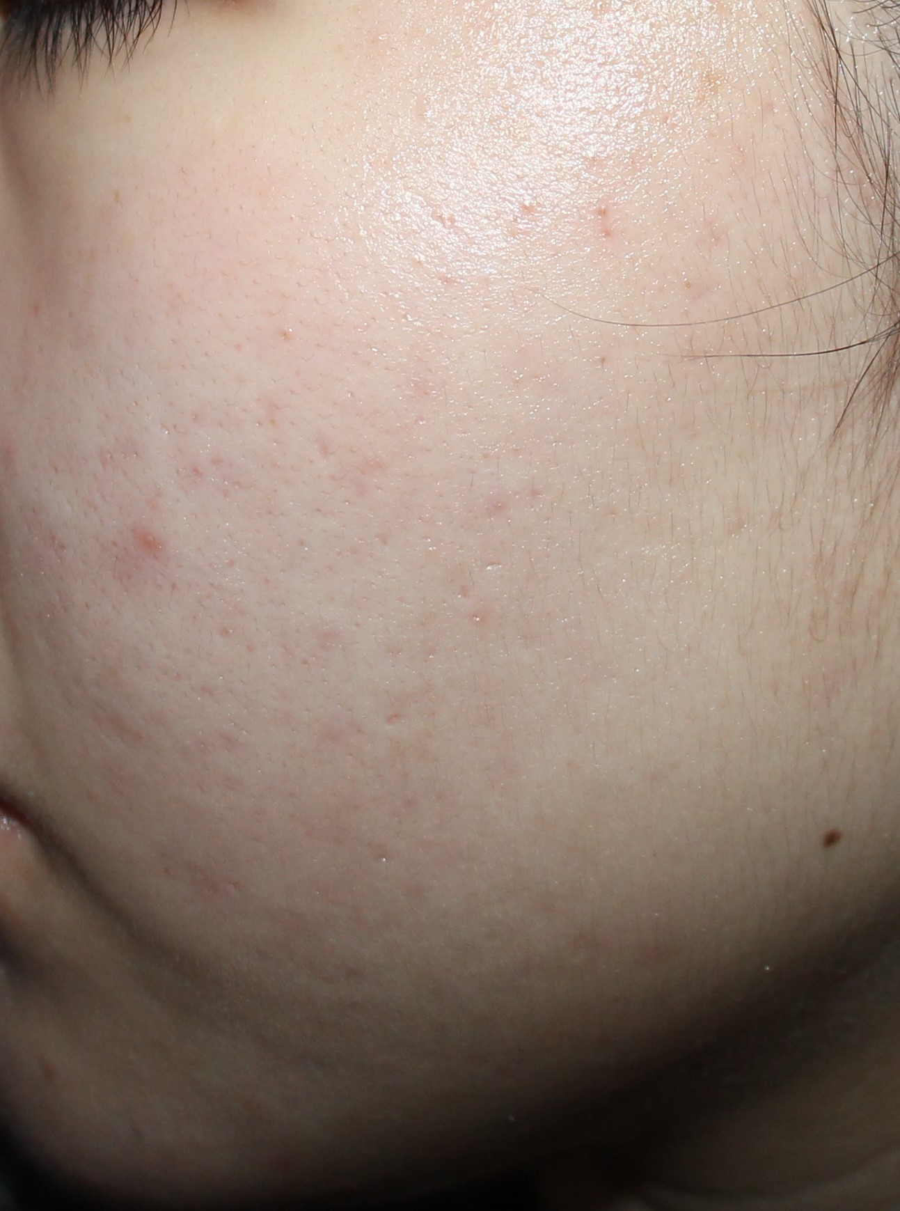 춘천모낭염 약초필링시술후 