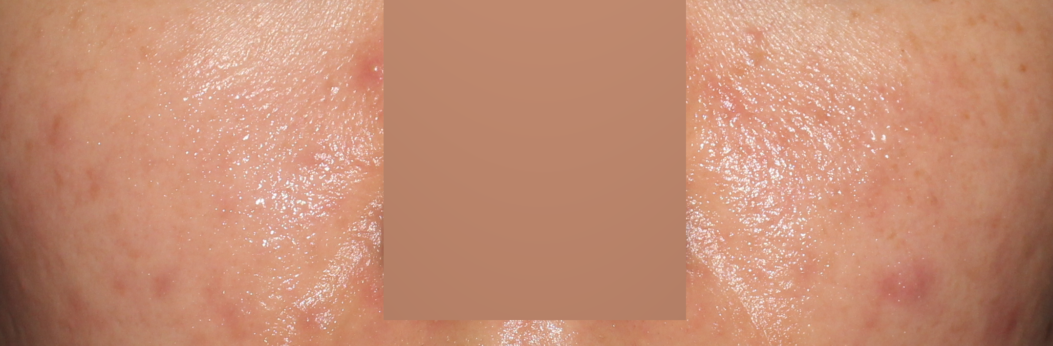 춘천화농성여드름 흉터치료후