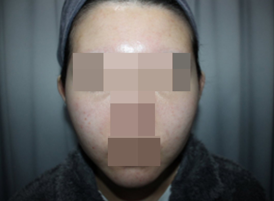 춘천여드름, 모낭염 치료&nbsp;후&nbsp;·&nbsp;정면